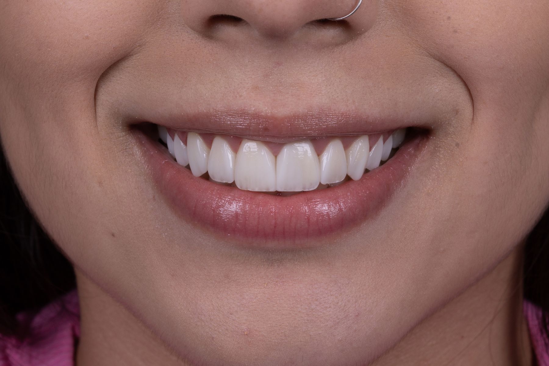Sorriso natural após tratamento com facetas